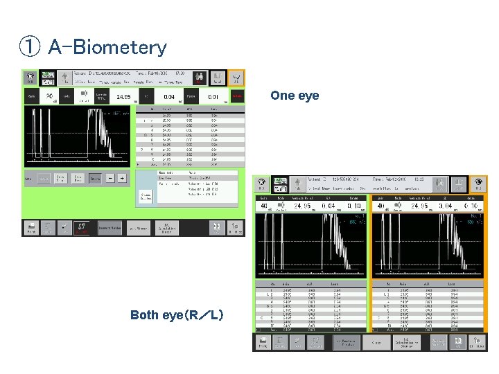 ① A-Biometery One eye Both eye（R／L） 