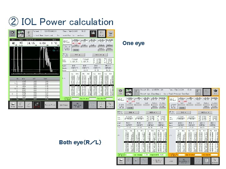 ② IOL Power calculation One eye Both eye（R／L） 