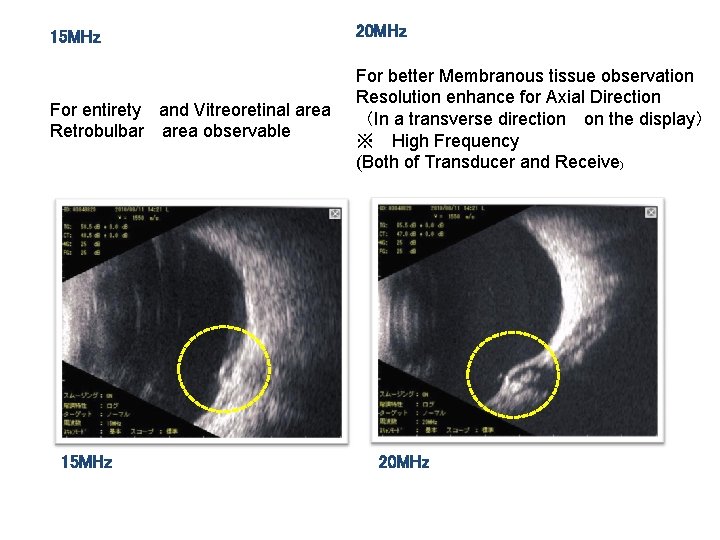 15 MHz 20 MHz For entirety and Vitreoretinal area Retrobulbar area observable For better