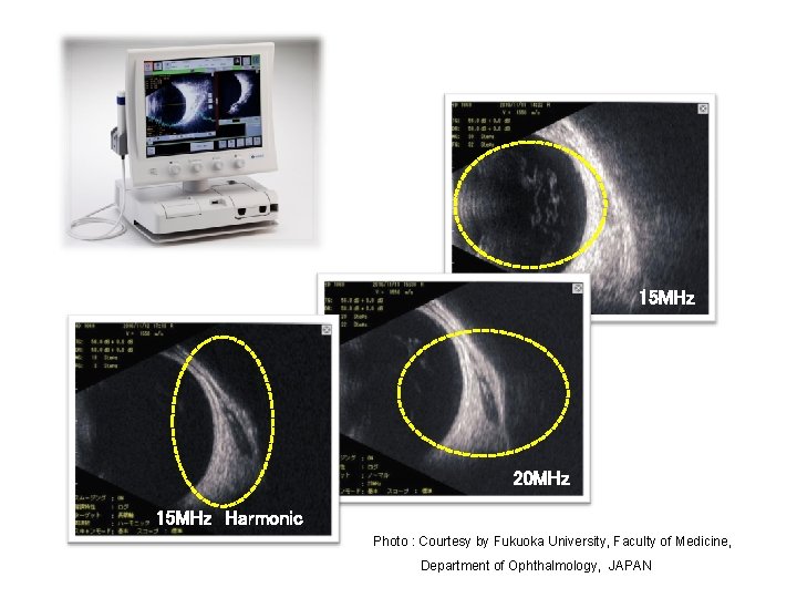 15 MHz 20 MHz 15 MHz Harmonic Photo : Courtesy by Fukuoka University, Faculty