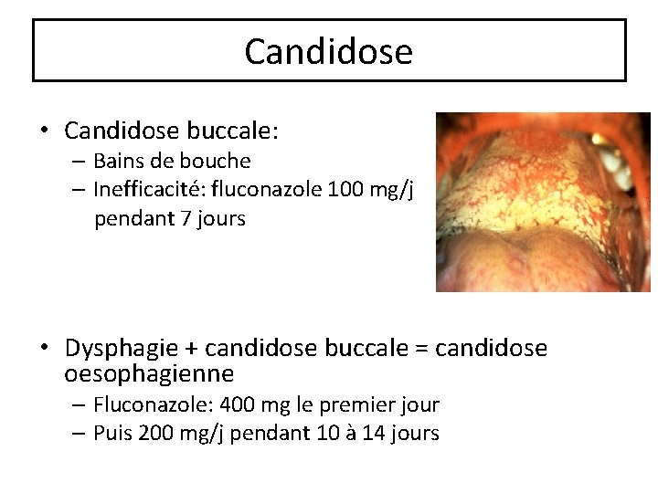 Candidose • Candidose buccale: – Bains de bouche – Inefficacité: fluconazole 100 mg/j pendant