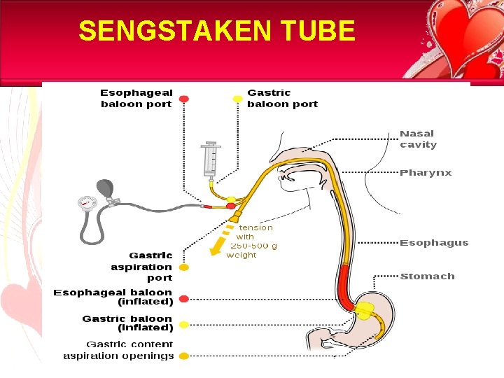 SENGSTAKEN TUBE 