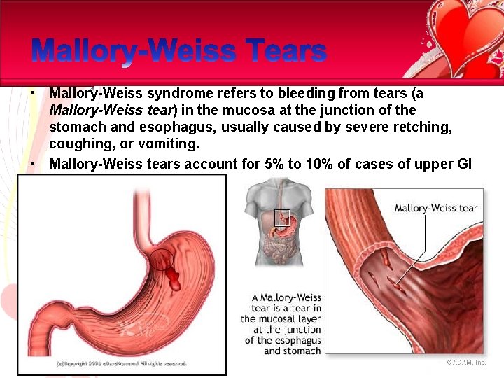  • Mallory-Weiss syndrome refers to bleeding from tears (a Mallory-Weiss tear) in the