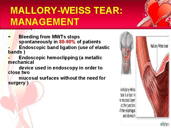 MALLORY-WEISS TEAR: MANAGEMENT - Bleeding from MWTs stops spontaneously in 80 -90% of patients