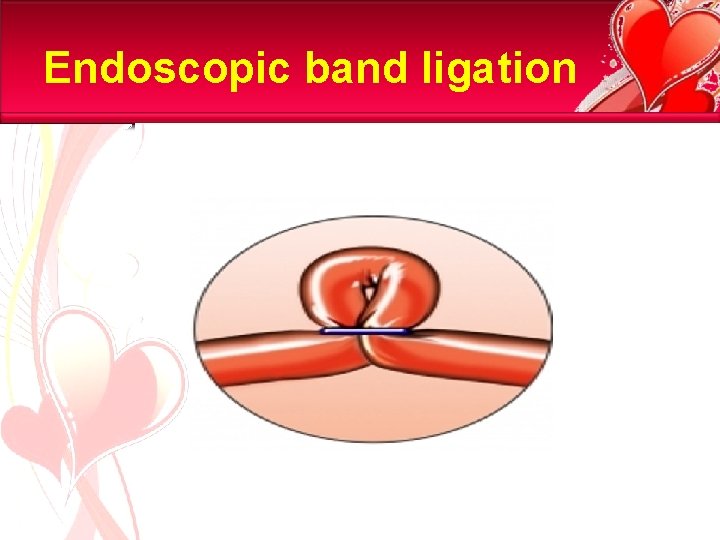 Endoscopic band ligation 