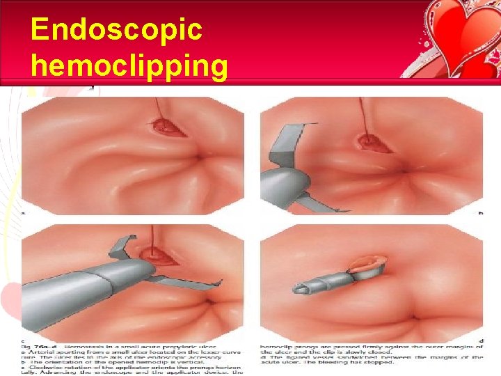 Endoscopic hemoclipping 15/81 