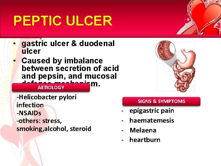 PEPTIC ULCER • gastric ulcer & duodenal ulcer • Caused by imbalance between secretion