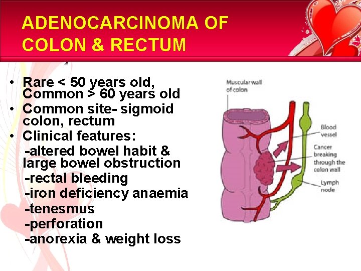 ADENOCARCINOMA OF COLON & RECTUM • Rare < 50 years old, Common > 60