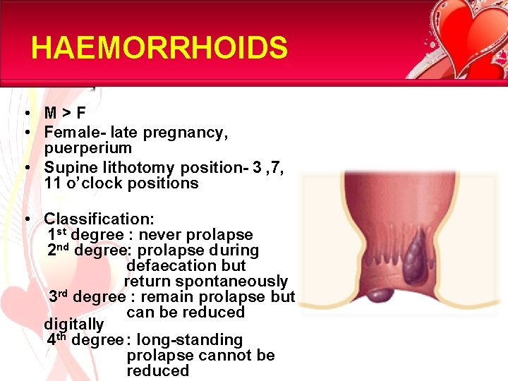 HAEMORRHOIDS • M>F • Female- late pregnancy, puerperium • Supine lithotomy position- 3 ,