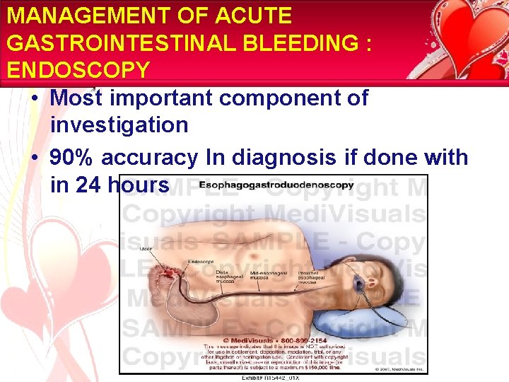 MANAGEMENT OF ACUTE GASTROINTESTINAL BLEEDING : ENDOSCOPY • Most important component of investigation •