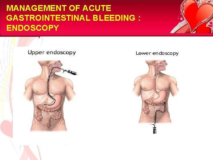 MANAGEMENT OF ACUTE GASTROINTESTINAL BLEEDING : ENDOSCOPY 