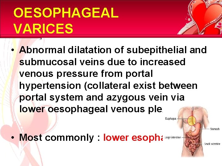 OESOPHAGEAL VARICES • Abnormal dilatation of subepithelial and submucosal veins due to increased venous
