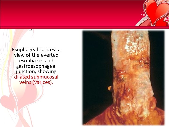 Esophageal varices: a view of the everted esophagus and gastroesophageal junction, showing dilated submucosal