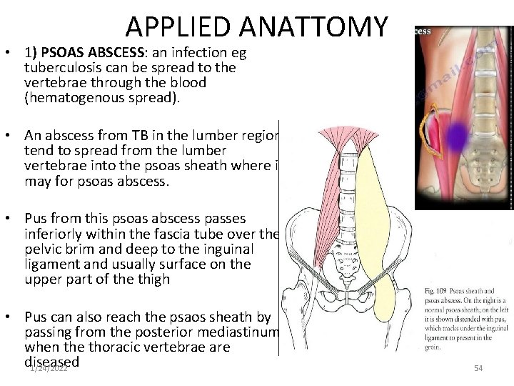 APPLIED ANATTOMY • 1) PSOAS ABSCESS: an infection eg tuberculosis can be spread to