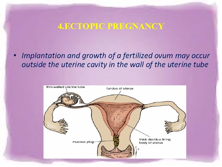 4. ECTOPIC PREGNANCY • Implantation and growth of a fertilized ovum may occur outside 4. ECTOPIC PREGNANCY • Implantation and growth of a fertilized ovum may occur outside