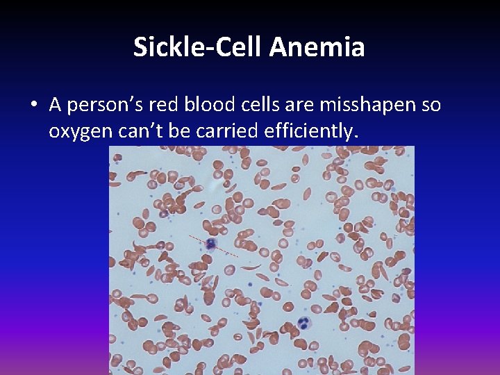 Sickle-Cell Anemia • A person’s red blood cells are misshapen so oxygen can’t be