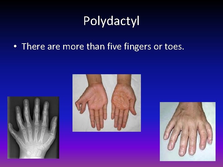 Polydactyl • There are more than five fingers or toes. 