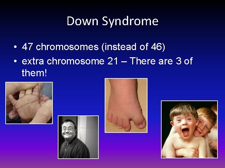 Down Syndrome • 47 chromosomes (instead of 46) • extra chromosome 21 – There