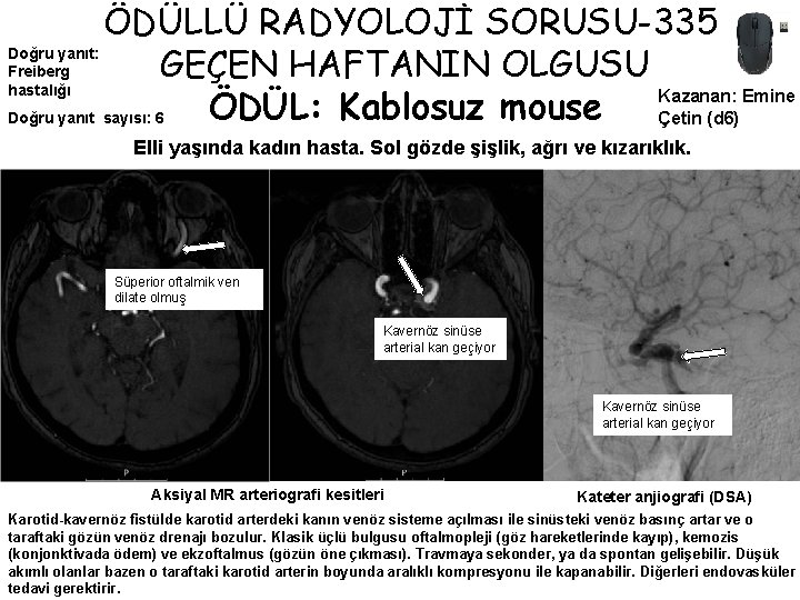 ÖDÜLLÜ RADYOLOJİ SORUSU-335 Doğru yanıt: GEÇEN HAFTANIN OLGUSU Freiberg hastalığı Kazanan: Emine ÖDÜL: Kablosuz