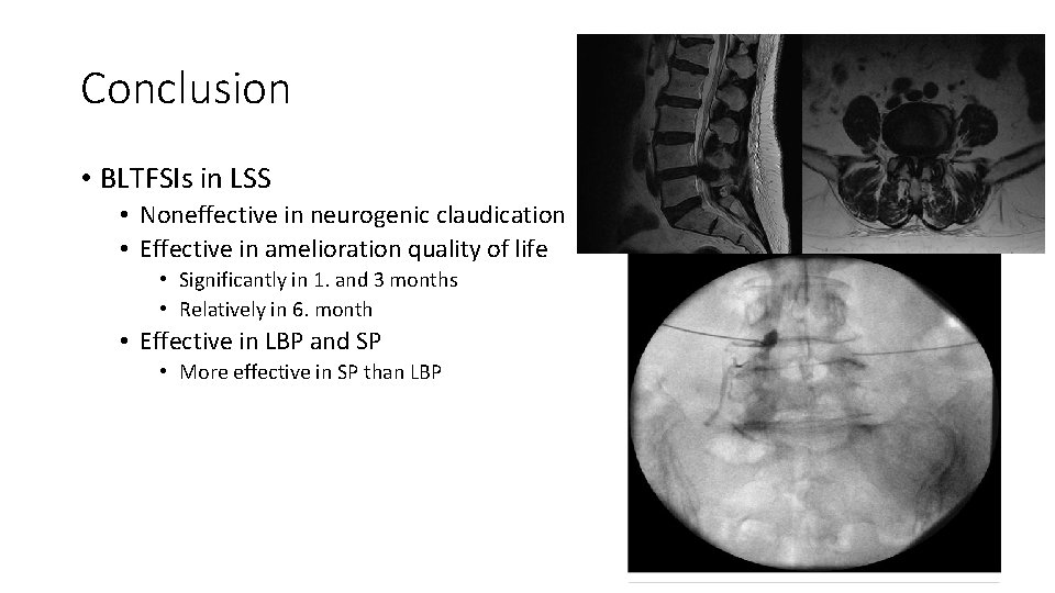 Conclusion • BLTFSIs in LSS • Noneffective in neurogenic claudication • Effective in amelioration