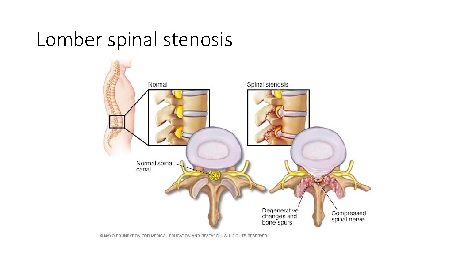 Lomber spinal stenosis 