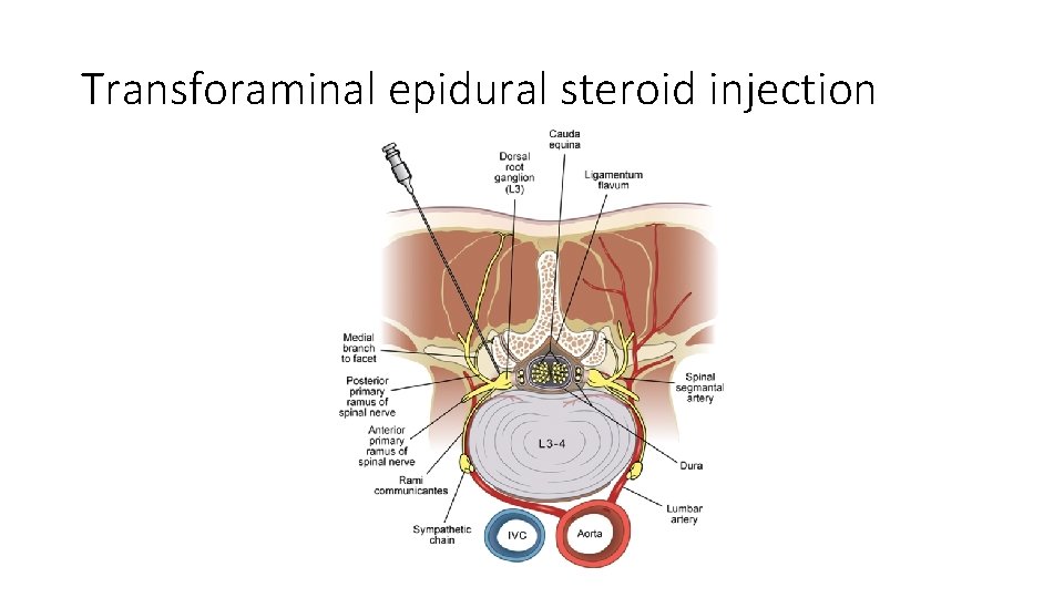 Transforaminal epidural steroid injection 