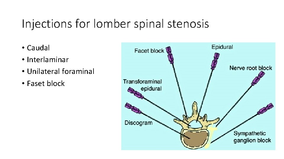 Injections for lomber spinal stenosis • Caudal • Interlaminar • Unilateral foraminal • Faset