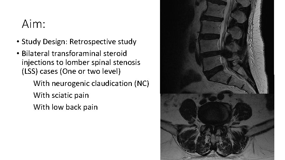 Aim: • Study Design: Retrospective study • Bilateral transforaminal steroid injections to lomber spinal