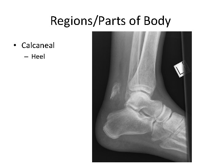 Regions/Parts of Body • Calcaneal – Heel 