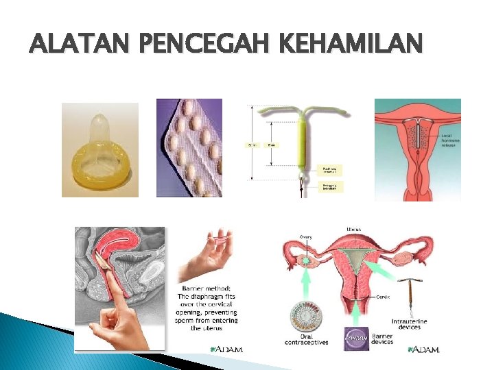 ALATAN PENCEGAH KEHAMILAN 