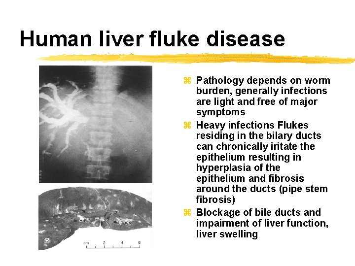 Human liver fluke disease z Pathology depends on worm burden, generally infections are light