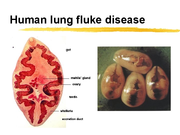 Human lung fluke disease 