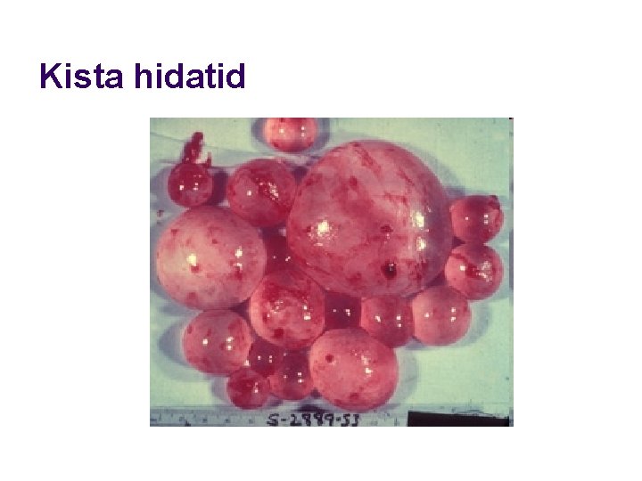 Kista hidatid 