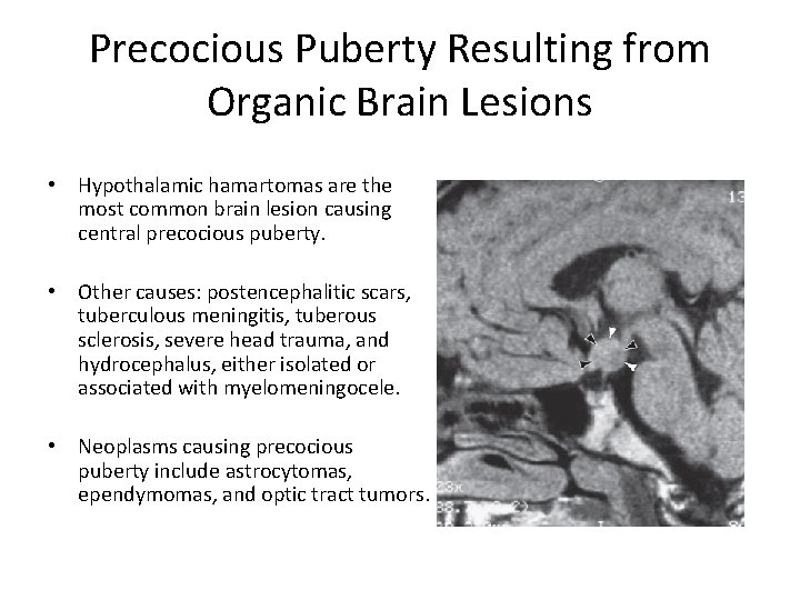 Precocious Puberty Resulting from Organic Brain Lesions • Hypothalamic hamartomas are the most common