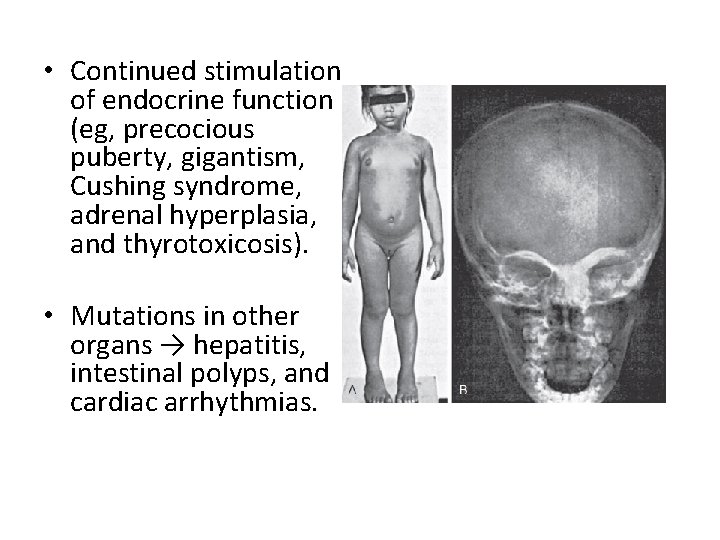  • Continued stimulation of endocrine function (eg, precocious puberty, gigantism, Cushing syndrome, adrenal