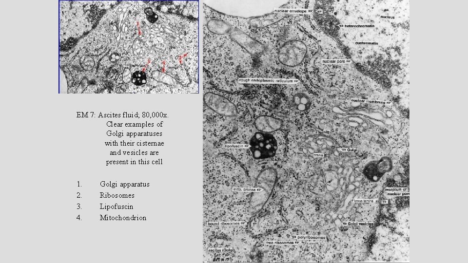 EM 7: Ascites fluid; 80, 000 x. Clear examples of Golgi apparatuses with their