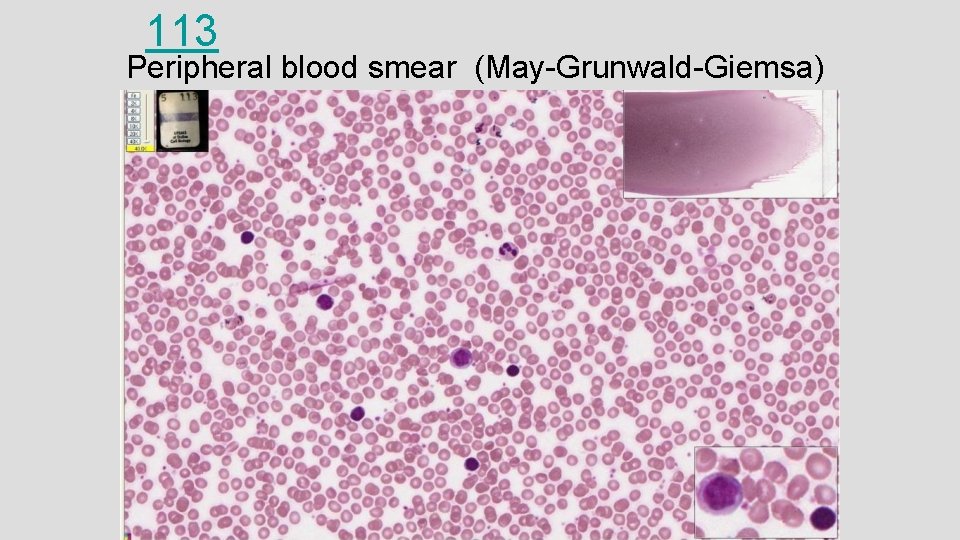 113 Peripheral blood smear (May-Grunwald-Giemsa) 