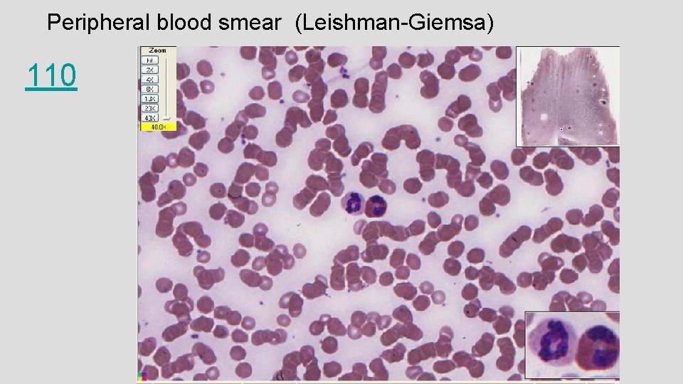 Peripheral blood smear (Leishman-Giemsa) 110 