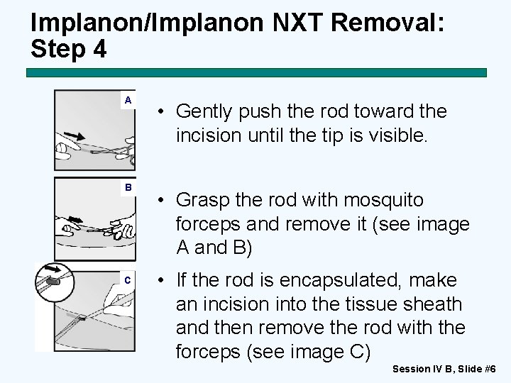Implanon/Implanon NXT Removal: Step 4 A B C • Gently push the rod toward