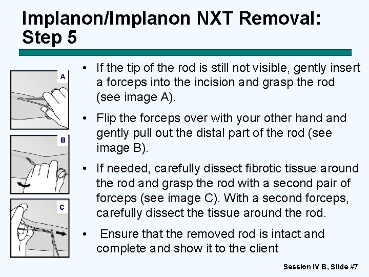 Implanon/Implanon NXT Removal: Step 5 A B C • If the tip of the