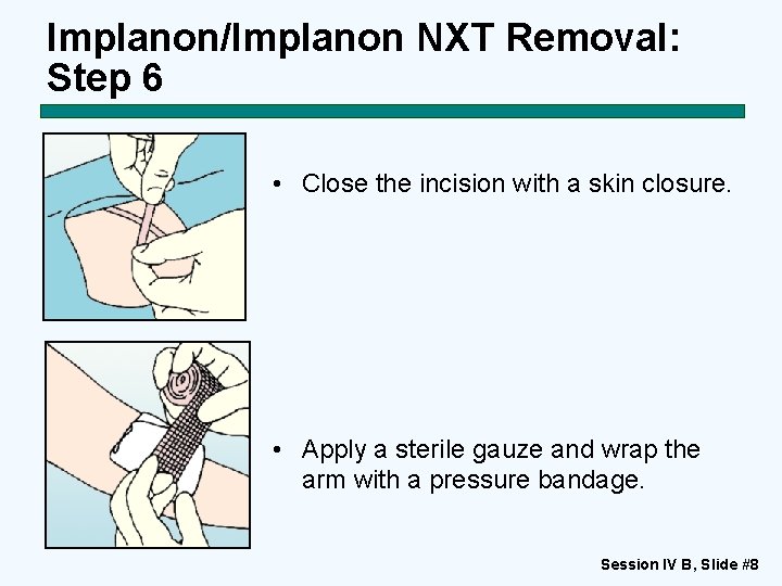 Implanon/Implanon NXT Removal: Step 6 • Close the incision with a skin closure. •