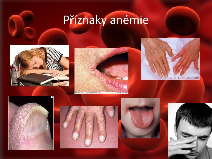 Příznaky anémie 