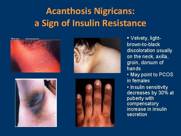 Acanthosis Nigricans: a Sign of Insulin Resistance • Velvety, lightbrown-to-black discoloration usually on the