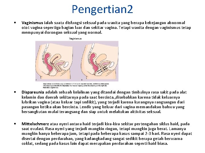 Pengertian 2 Vaginismus ialah suatu disfungsi seksual pada wanita yang berupa kekejangan abnormal otot