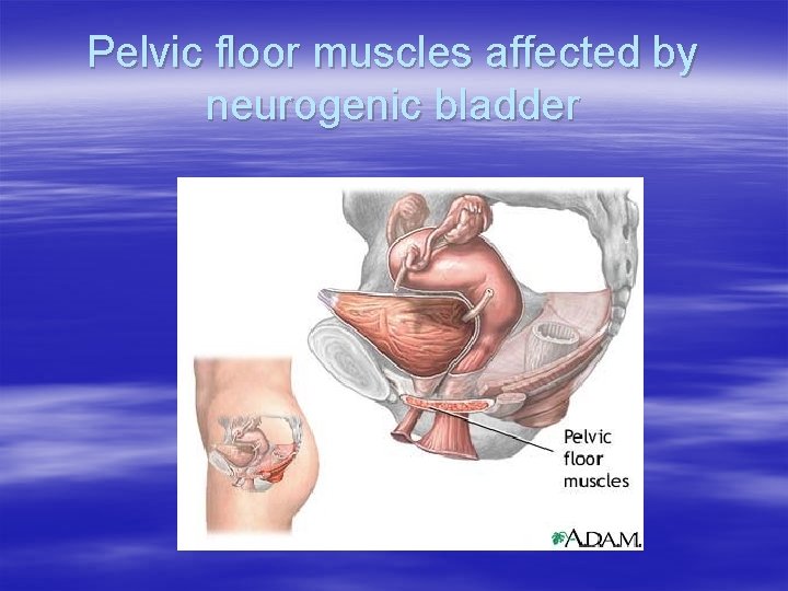 Pelvic floor muscles affected by neurogenic bladder 