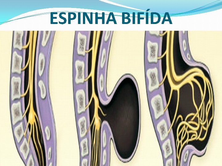 ESPINHA BIFÍDA 