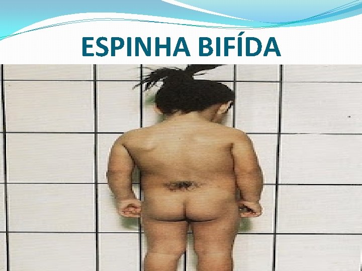 ESPINHA BIFÍDA 