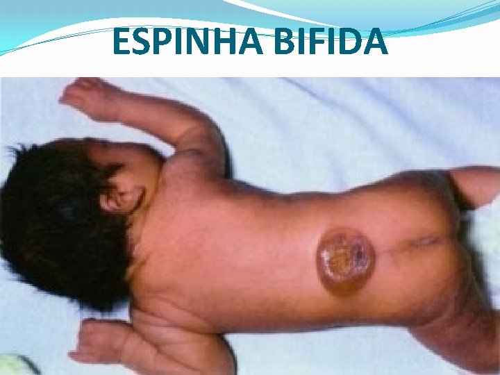 ESPINHA BIFIDA 