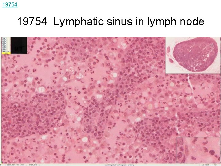 19754 Lymphatic sinus in lymph node 