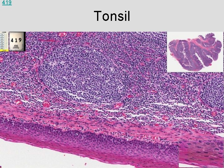 419 Tonsil 